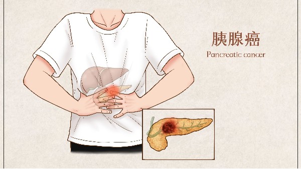 警惕胰腺癌，留意這四個預(yù)警信號