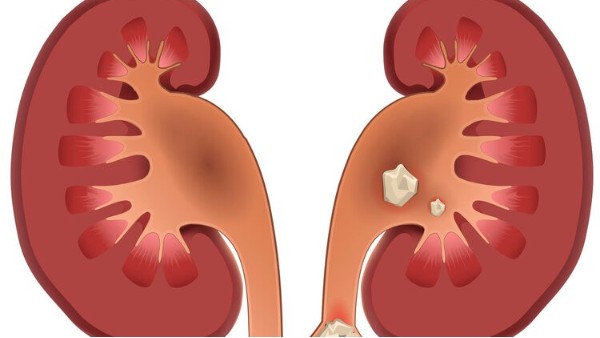 30歲男子喝茶喝出腎結(jié)石，多喝水和多喝茶，到底哪個更健康？