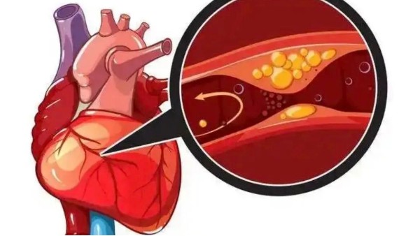 真實案例：是什么讓他堅持一年，冠狀動脈堵塞消除30%！