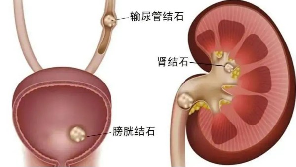 重用、活用水蛭治療尿路結(jié)石，療效較好