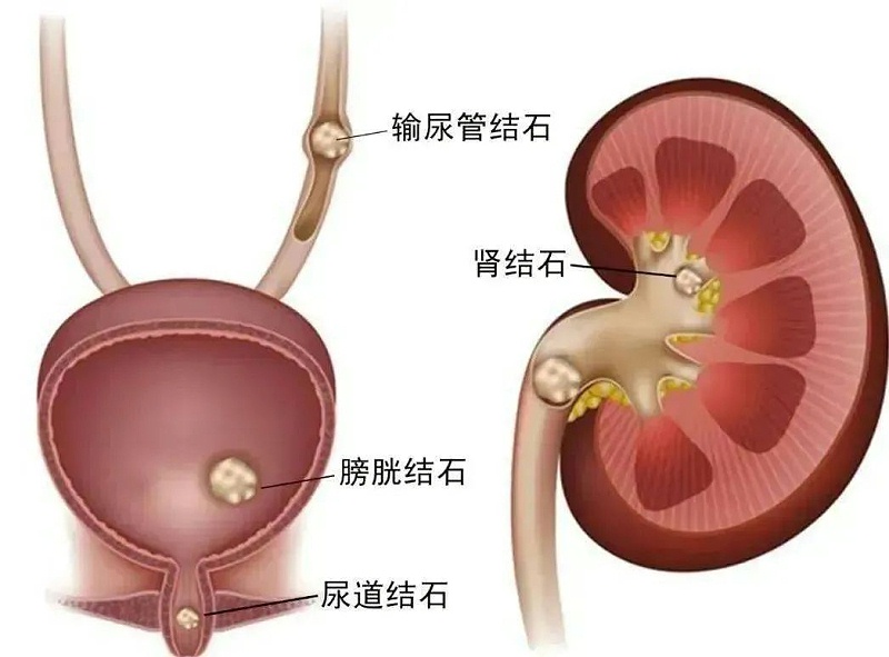 水蛭素、尿路結(jié)石、腎功能