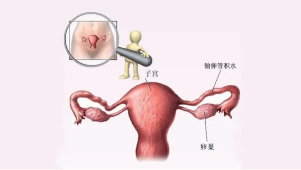 水蛭有利水道、破積聚之功，可用于治療輸卵管積水