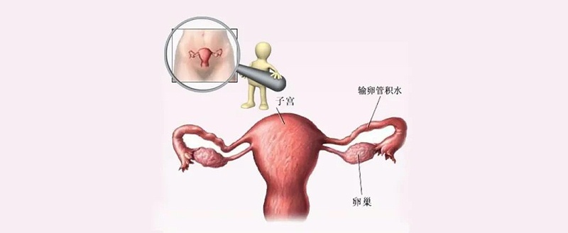 水蛭素、輸卵管積水、不孕不育