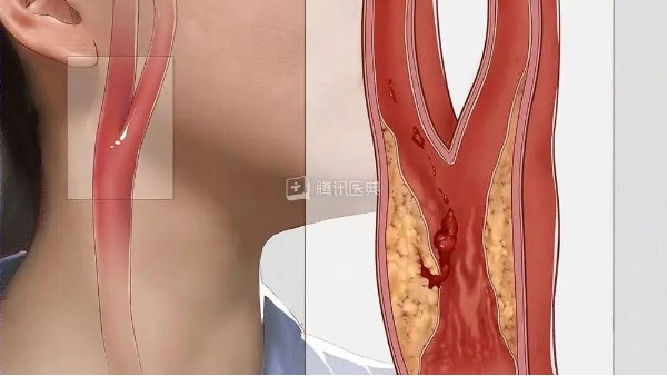 真實案例丨3個月左頸動脈狹窄降低約27%，是怎么實現(xiàn)的？