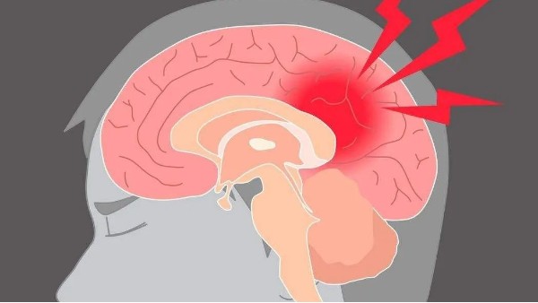 水蛭治療缺血性腦血管病療效肯定、安全簡便，已被各家公認(rèn)