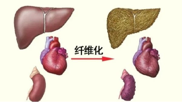 水蛭是臨床常用的活血藥物，能有效治療器官纖維化