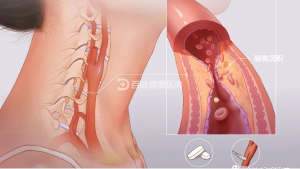 真實(shí)案例 | 從有到無(wú)，一個(gè)月多雙頸動(dòng)脈斑塊“消失術(shù)”