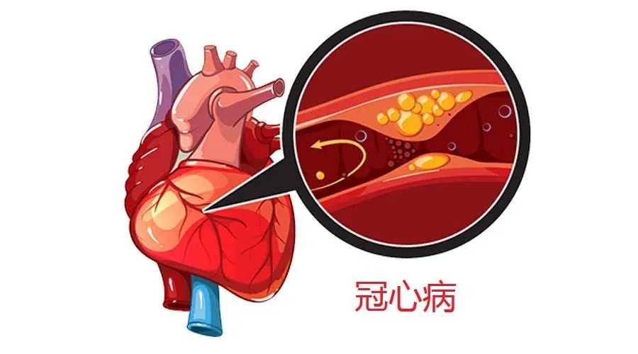 冠心病的“時間療法”