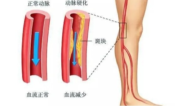 水蛭在改善下肢動(dòng)脈硬化性閉塞癥中發(fā)揮重要療效，安全性及可行性較高