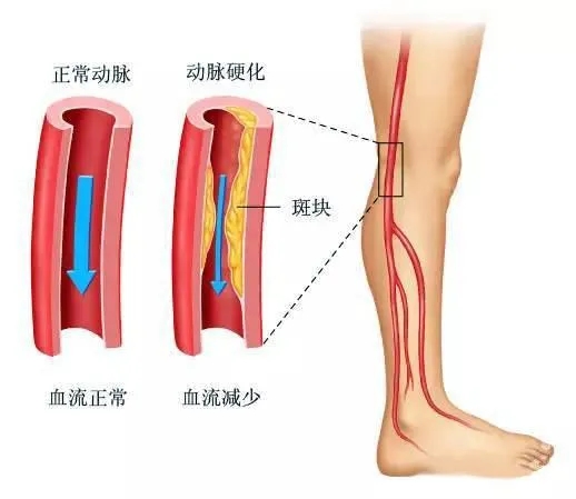 水蛭素、下肢動(dòng)脈硬化、下肢閉塞