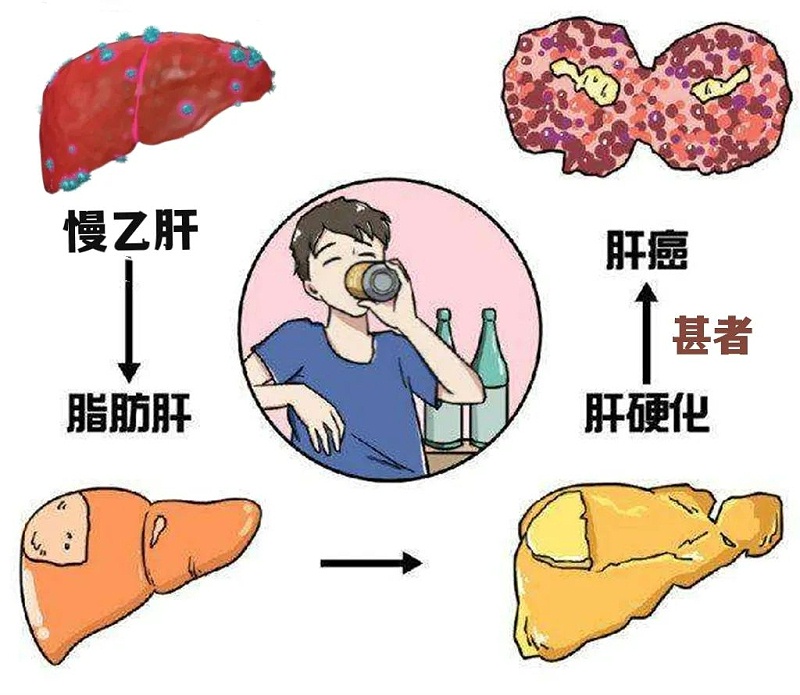 水蛭素、肝硬化、脂肪肝