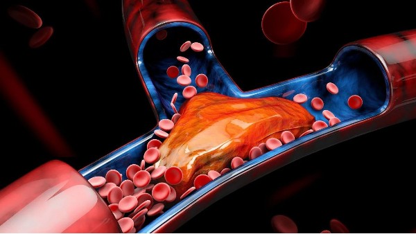 血栓最容易堵在身體3個地方！有這4個信號一定要留意→
