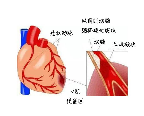 中醫(yī)藥健康旅游、心梗、面癱