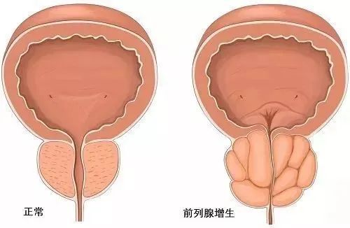 水蛭素、前列腺增生、前列腺肥大