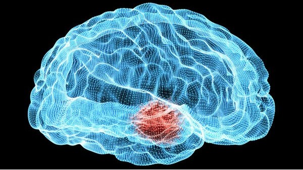 Stroke：劇烈頭痛、惡心、嘔吐……擔(dān)心這種“腦內(nèi)定時(shí)炸彈”！