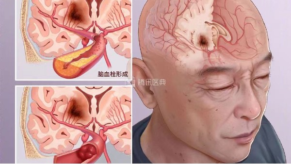 腦血栓疾病的日常防護