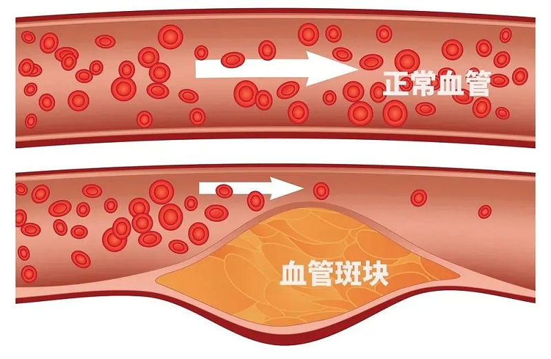 水蛭素、通血管、血管堵塞