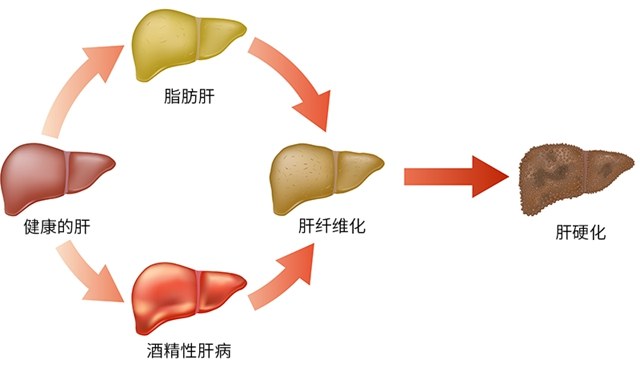 檢查出脂肪肝，該怎么治？