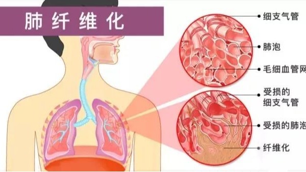 研究稱水蛭素可通過(guò)調(diào)控p38 MAPK/NF-κB信號(hào)通路抗肺纖維化