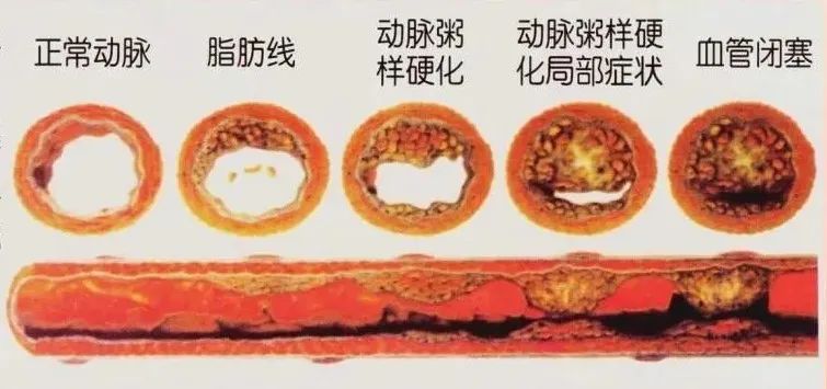 水蛭素、動脈粥樣硬化、高血壓