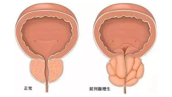 水蛭在改善前列腺增生臨床癥狀、提高生活質(zhì)量方面發(fā)揮重要作用