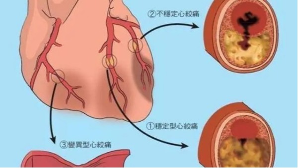 尿酸高不僅導致痛風，還可能威脅你的心臟和大腦！