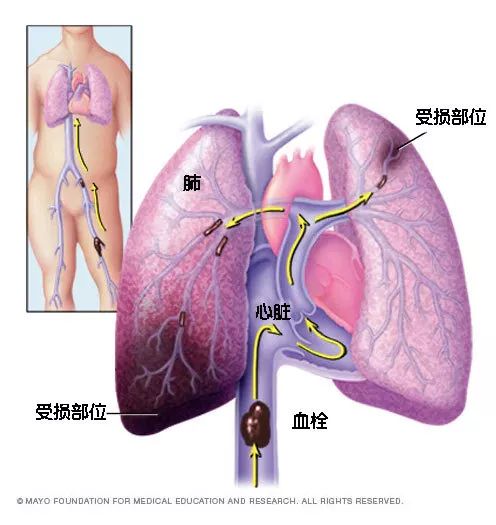 水蛭素、猝死、心梗